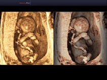 Эмбрион, режимы Surface + VSI, 3D