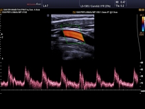 Общая сонная артерия, триплексный режим (B+CFM+PW)