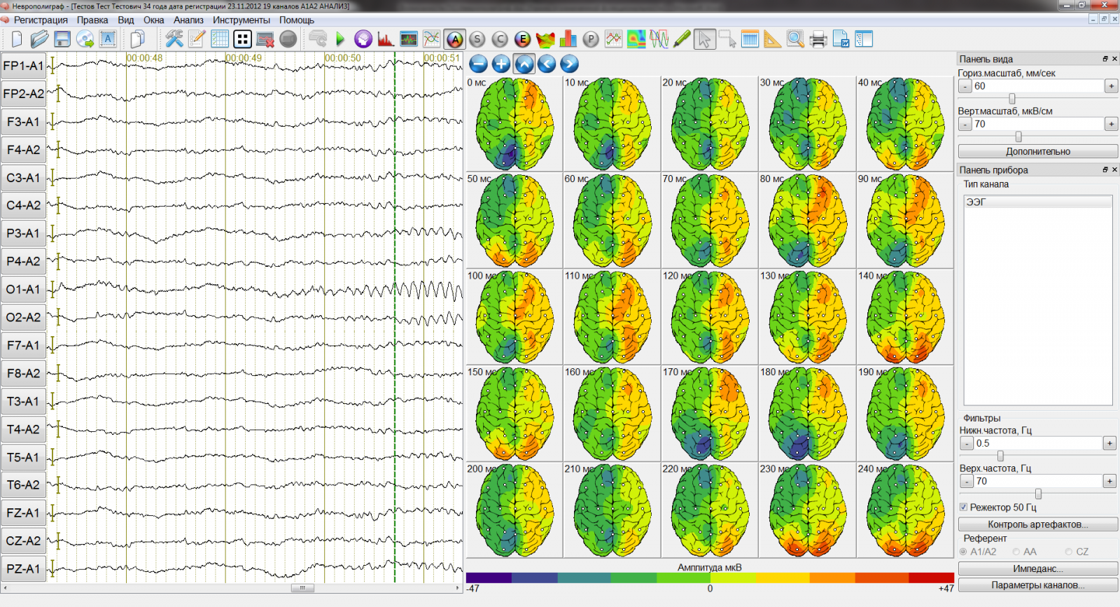 Регистрация активности мозга. ЭЭГ картирование головного мозга. Топографическое картирование электрической активности мозга. Метод картирования ЭЭГ. Картирование электрической активности мозга с помощью ЭЭГ.