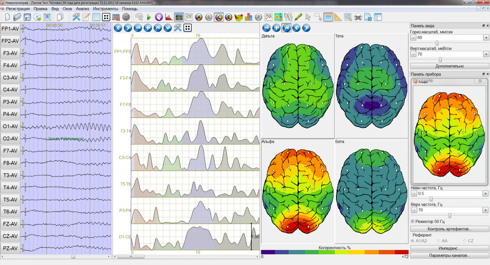 Ээг 6. Картирование электрической активности мозга. Картирование мозга ЭЭГ. Электроэнцефалография головного мозга (ЭЭГ). Компьютерная ЭЭГ С картированием головного мозга.