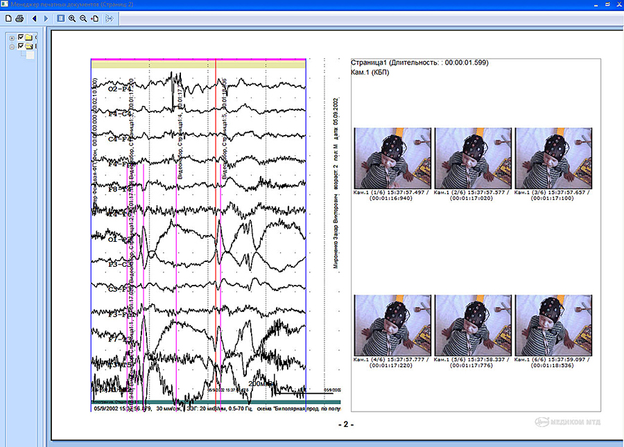 Ээг вм. 6 Часовой ЭЭГ мониторинг. ЭЭГ ночной мониторинг ребенку. Видеомониторинг ЭЭГ при эпилепсии. ЭЭГ ночное мониторирование сна.