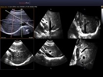 Печень, режим Multi OVIX, 3D