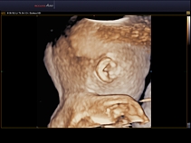 Плод, голова, режим VSI, 3D