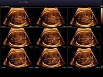 Плод, головной мозг, режим MSV, 3D