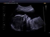 Плод, лицо, THI + DMR