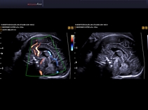 Плод, мозг, режим DPDI, THI + DMR