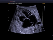 Плод, сердце, 4-х камерная позиция