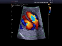 Плод, сердце, ЦДК