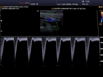 Подколенная артерия, триплексный режим (B+CFM+PW)