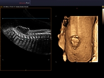 Порок развития плода - spina bifida, 3D