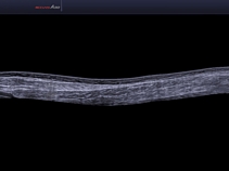 Икроножная мышца, панорамное сканирование