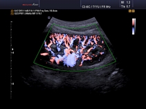 Почка, сосуды, режим S-flow