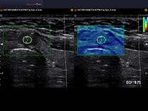 Щитовидная железа, аденома перешейка, эластография
