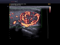 Щитовидная железа, аденома, энергетический допплер