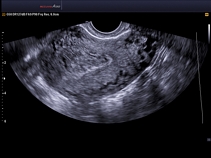 Матка, эндометриоз, B-режим + SRF