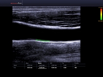 Общая сонная артерия, AutoIMT