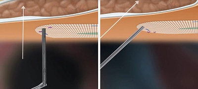 Эндоскопический изгибаемый перезаряжаемый герниостеплер с рассасывающимися гвоздями ReliaTack™