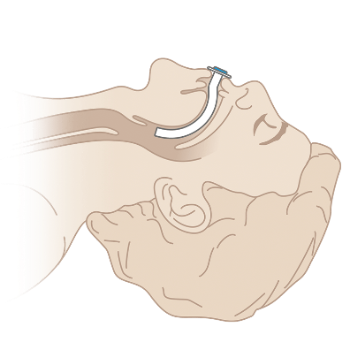 Орофарингеальные воздуховоды DAR™