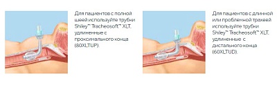 Tracheosoft™ XLT Экстрадлинные гибкие трахеостомические трубки со сменными внутренними канюлями