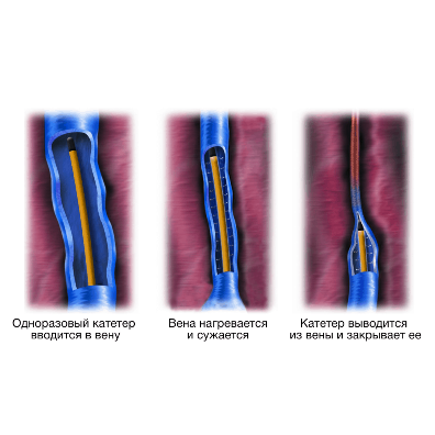 Aппарат для радиочастотной абляции варикозных вен нижних конечностей ClosureFast™ RFG 3
